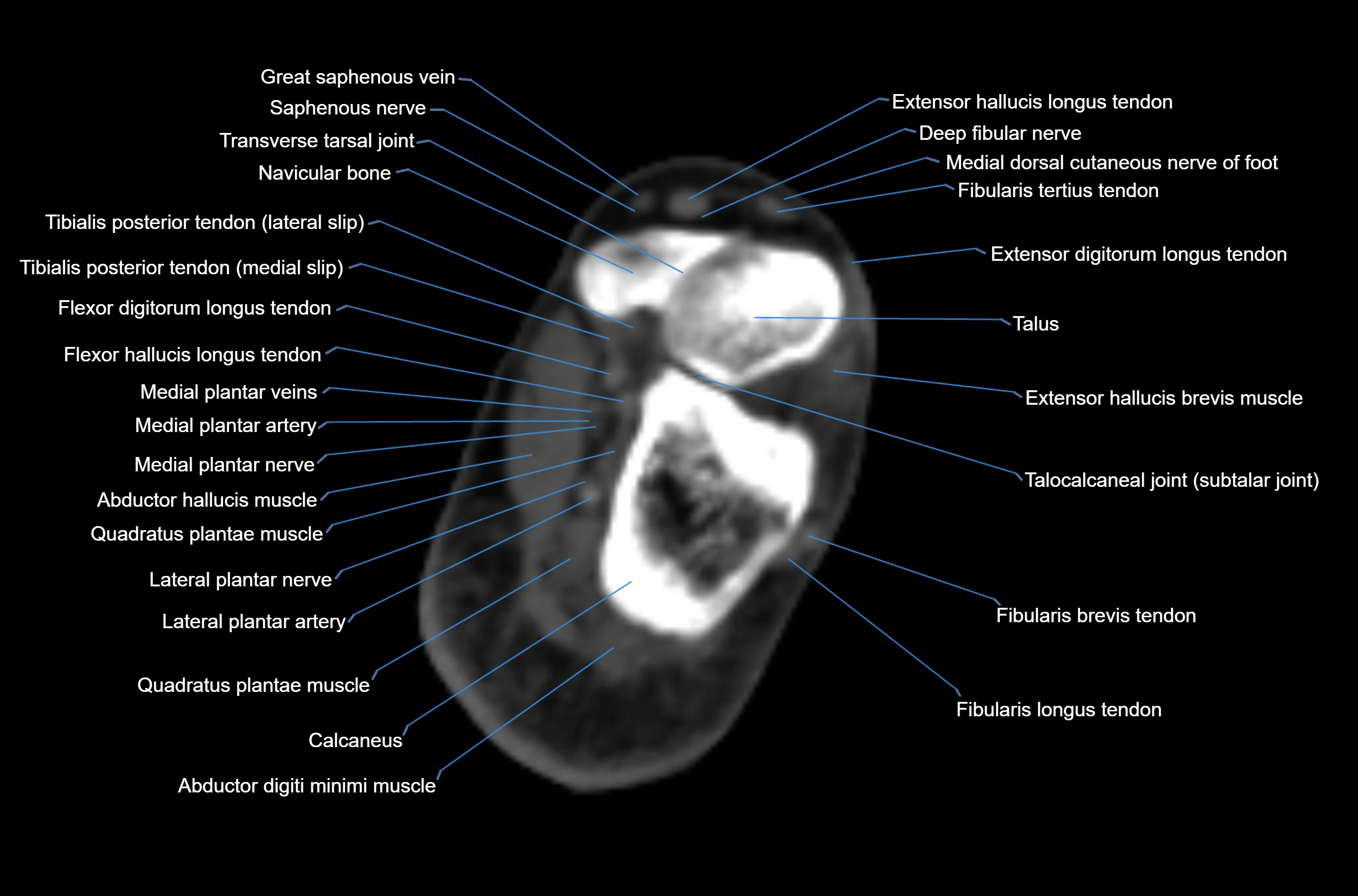 CT Ankle axial cross sectional anatomy labelled image -00042.webp